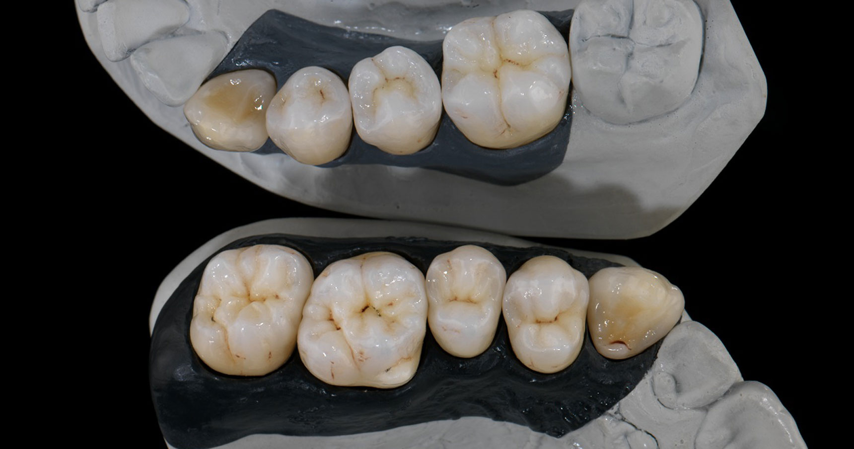 Зуб 1.4. Зуб 3.6 анатомия коронки.